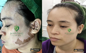 Laser melasma khắc tinh của chàm bớt bẩm sinh