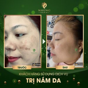 Tăng sắc tố da đã có laser melasma