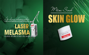 Laser Melasma kết hợp Mầm sinh cho bộ đôi hoàn hảo