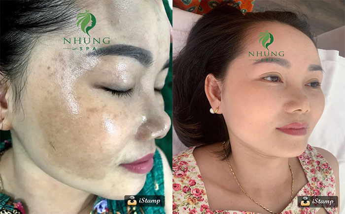 Nám Melasma Là Gì? Tìm Hiểu Nguyên Nhân, Triệu Chứng Và Cách Điều Trị