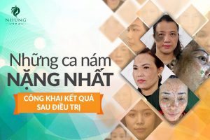 Nám sạm, chàm bớt làm sao để điều trị tận gốc?