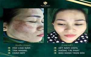 Plus Melasma hết nám da trong tích tắc