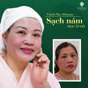 Plus Melasma trị nám da mọi cấp độ