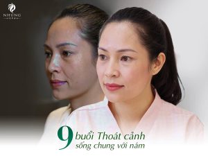 Plus Melasma khai tử nám sạm lâu năm