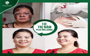 Plus Melasma chàm bớt không còn là nỗi lo