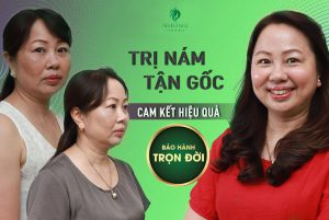 Những băn khoăn trăn trở của khách hàng khi trị nám