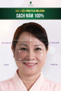 Trực tiếp quá trình điều trị nám tàn nhang tại Nhung Spa bằng Công Nghệ Plus Melasma đã điều trị thành công cho hơn 10.000 chị em trên cả nước.