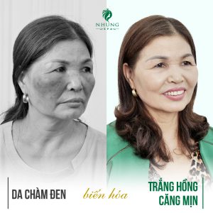 Chàm Đen Nám Sạm Bao Năm Khi Đến Nhung Spa Bật Chân Trắng Hồng Chỉ Sau 9 Buổi.