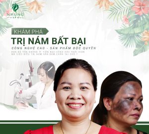 Tại Sao Trị Nám Tại Nhung Spa Lại Hiệu Quả Như Vậy – Hãy Cùng Khám Phá Phác Đồ Trị Nám Và Công Nghệ Plus Melasma Tại Nhung Spa Ngay Nào.