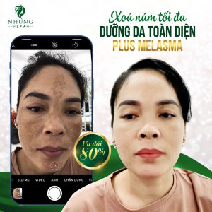 Trải Nghiệm Miễn Phí Điều Trị Nám, Tàn Nhang Bằng Công Nghệ Plus Melasma Tại Nhung Spa.