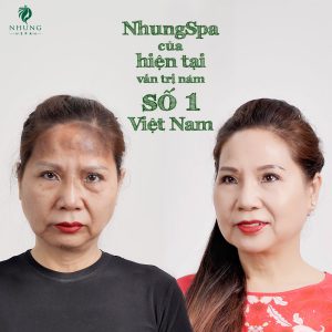 Liệu Trình 09 Buổi Nhưng Đến Buổi Thứ 08 Đã Xóa Sạch Mọi Vết Nám Trên Da Mặt Chỉ Có Tại Nhung Spa