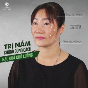 Điều Trị Nám Tàn Nhang Bằng Công Nghệ Plus Melasma Tại Nhung Spa