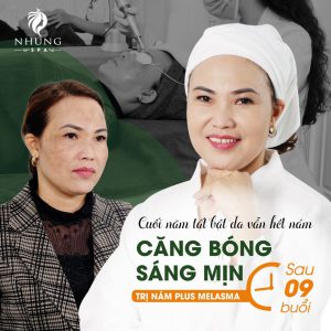 Nhung Spa Đã Giúp Hàng Nghìn Chị Em Phụ Nữ Khỏi Nám Mặt, Nám Lâu Năm Và Tàn Nhang Chỉ Sau 09 Buổi.