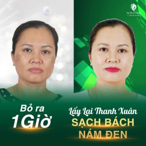 Bỏ Ra 1 Giờ Lấy Lại Thanh Xuân Sạch Bách Nám Đen Trên Gương Mặt 