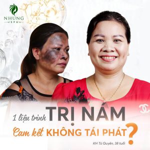 Mặt Nhọ Nồi Kèm Nám Chiếm Nửa Khuôn Mặt Làm Sao Để Vượt Qua Lỗi Sợ Này?