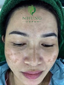 Combo Vạn Người Mê Và Sự Lột Xác Hoàn Toàn Khi Sử Dụng Combo Mầm Sinh tại Nhung Spa