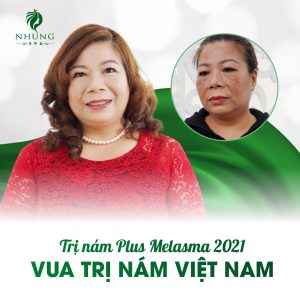 VUA TRỊ NÁM PLUS MELASMA GÂY SỐC BỞI TRỊ NÁM TRONG 09 BUỔI