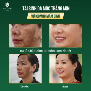 MẶT MỘC DA VẪN MƯỚT CHỈ CÓ THỂ LÀ SAU PEEL DA BẰNG MẦM SINH