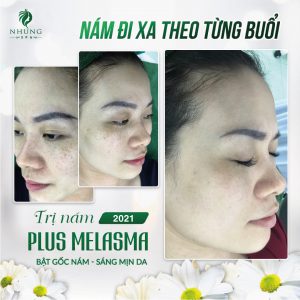 Nám Biến Chứng Hỏng Da – Hành Trình Lấy Lại Nhan Sắc Của Chị Liên Tại Nhung Spa Mời Chị Em Cùng Đón Xem