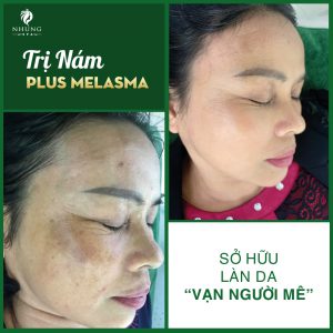 Sở Hữu Làn Da Vạn Người Mê Thời Thanh Xuân – Bằng Công Nghệ Trị Nám Tại Nhung Spa