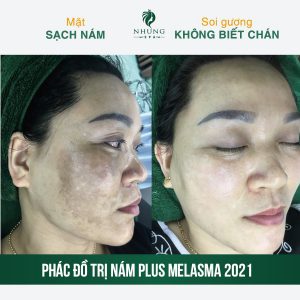 HÌNH ẢNH CHỊ HÀ PHƯƠNG SAU TRỊ NÁM NHÀ NHUNG DƯỚI ĐÂY NHÉ – MỜI CHỊ EM CÙNG TÌM HIỂU 