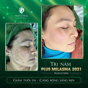 Chị Khách hàng 32 tuổi đến từ Tuyên Quang trị nám bằng Plus Melasma – Ký Cam Kết An Toàn Và Hiệu Quả