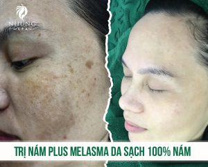 Sạch 100% nám Sáng Da – Trị Nám Hiệu Quả Với Công Nghệ Xu Hướng 2021 Plus Melasma