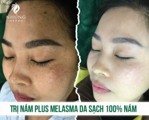 Ám Ảnh Bởi Nám – Hãy Đến Nhung Spa Sau 1 Liệu Trình Khỏi Hoàn Toàn