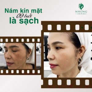 Sống chung với Nám gần 10 năm, chị T.N nhiều lần cảm thấy bế tắc, mệt mỏi vì điều trị nám mãi mà vẫn không thấy hiệu quả.