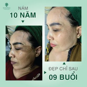 BẮT TREND XU HƯỚNG TRỊ NÁM 2021 PLUS MELASMA TẠI NHUNG SPA – KHỎI HOÀN TOÀN CHỈ SAU 09 BUỔI