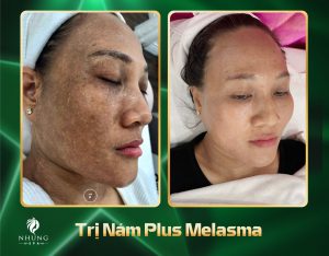 ĐỘ TUỔI NÀO NÊN TRỊ NÁM BẰNG LASER ?