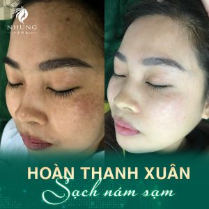 Khủng Hoảng Khi Từ Làn Da Sáng Mịn – Sau Sinh Bỗng Chốc Chi Chít Tàn Nhang