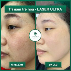 TRỊ NÁM TRẺ HÓA DA LẤY LẠI NHAN SẮC – CÔNG NGHỆ LASER ULTRAL 24K HIỆN ĐẠI NHẤT 2021