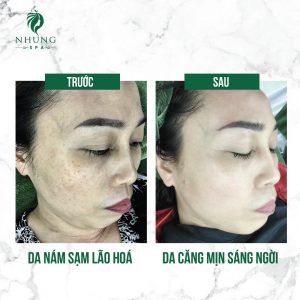 KHƯỚC TỪ NÁM SẠM – TỰ TIN DIỆN MẠO MỚI – LẤY LẠI NHAN SẮC TẠI NHUNG SPA