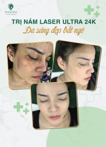 SẠCH BÁCH NÁM SÂU CHỈ 01 LIỆU TRÌNH LASER ULTRA 2022