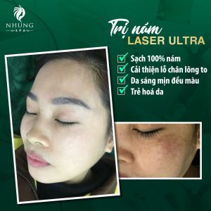 NÁM LÂU BÁM RỄ – BẬT NGAY TỨC THÌ KHI CÓ LASER ULTRA 2022