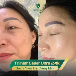 NÁM MẢNG KHÓ TRỊ LÀM SAO – LOẠI BỎ 85% NÁM CHỈ SAU 01 BUỔI