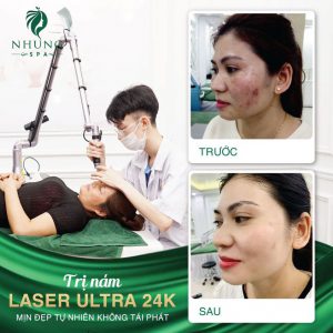 Trước Và Sau Khi Điều Trị Nám Bằng Công Nghệ Laser Ultral 24k Tại Nhung Spa