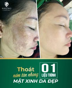 Laser Ultral 24K – Công Nghệ Vàng Trong Làng Trị Nám