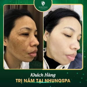 THOÁT GIÀ NHỜ TRỊ NÁM – TRỊ NÁM TRẺ HÓA LASER ULTRA 24K