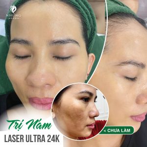 MUỐN HẾT NÁM, SÁNG DA ĐỪNG BỎ QUA LASER ULTRA 24K