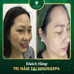 NĂM HẾT TẾT SANG – THANH LÝ NÁM SẠM ĐÓN TẾT TRỌN VẸN CÙNG NHUNG SPA NGAY NÀO