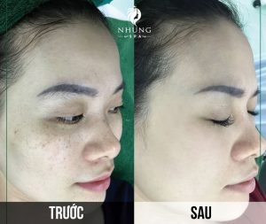 Siêu Vi Điểm Cao Cấp Điều Trị Nám Tận Gốc