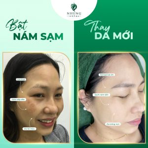 Nám Bám Lâu – Khó Khăn Để Điều Trị Hãy Đến Nhung Spa Sạch Nám Tận Gốc