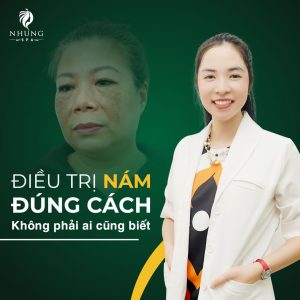 Chỉ 05 Buổi Sạch 100% Nám – Lấy Lại Vẻ Đẹp Rạng Ngời Ngay Nào