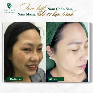 Tạm Biệt Nám Mảng Nám Chân Sâu Vĩnh Viễn – Chỉ Sau 01 Liệu Trình