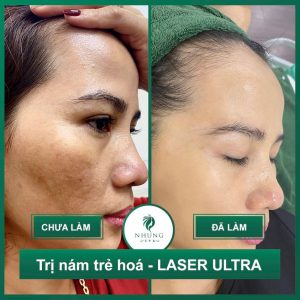 Phân Tích Làn Da Nám Sạm Của Chị 35 Tuổi Lần Đầu Đến Với Nhung Spa