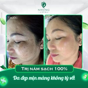 Trị Nám Sạch 100% – Lấy Lại Làn Da Đôi Mươi Đẹp Không Tỳ Vết Tại Nhung Spa