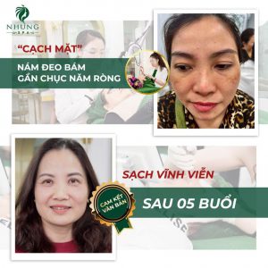 Nám Đeo Bám Chục Năm – Sạch Vĩnh Viễn Sau 05 Buổi Tại Nhung Spa