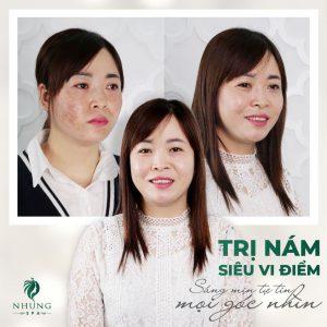 SẠCH NÁM SÁNG MỊN TỰ TIN – THU HÚT MỌI ÁNH NHÌN CÙNG NỮ HOÀNG TRỊ NÁM  SIÊU VI ĐIỂM